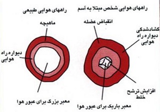 تصویر بیماری تنفسی آسم و عوامل آن